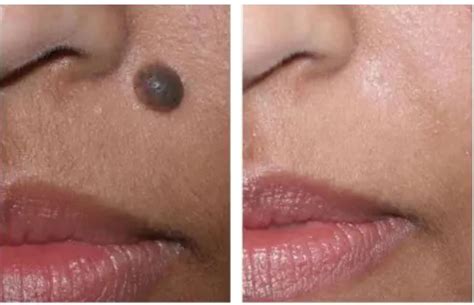 mole removal face